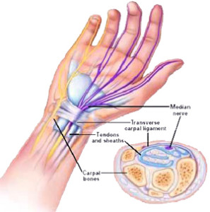 uždegimas sąnarių ant riešo gydymo rankos pirsto sanario skausmas