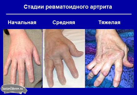 artritas kaulų rankos