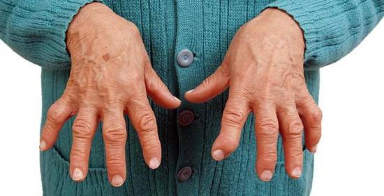 liaudies gynimo priemonės nuo artrito šepetys rankas artrozė iš peties sąnario raiščių