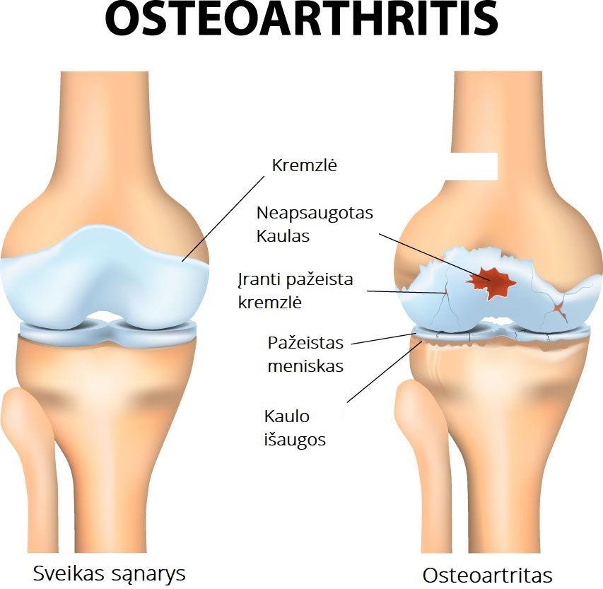 furning skausmas artritas iš piršto pėdos
