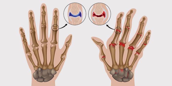 liaudies gynimo priemonės nuo artrito šepetys rankas standūs sujungimai vertus