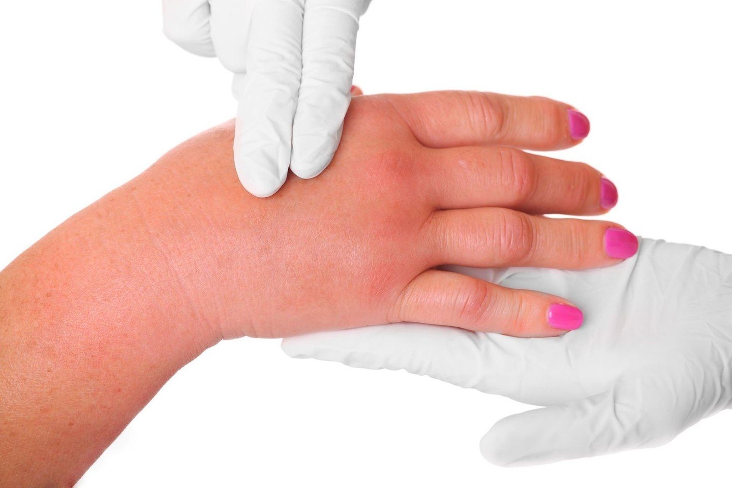pranešimo stramatic pirštų artrito ant rankų policzek artritas