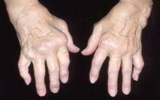 reumatoidinis artritas ranka peties