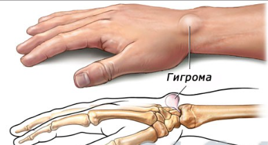 ranka riešo artrito gydymui artritas artrozė koks gydymas