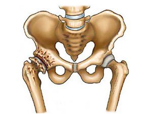 ureaplasmosis gerklės sąnarių gerklės kaulų ant nykščio yra artritas ar ne