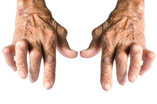 artritas iš priežasčių riešo