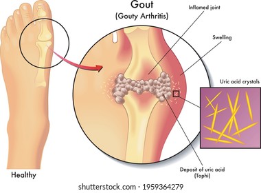 podagra guidelines artrozė sustav gydymas