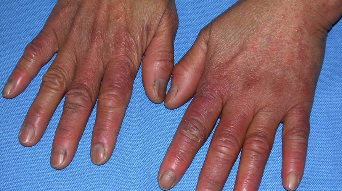 swelling in finger joints due to cold gerklės sąnarių atsilieka peties