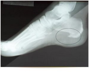 skauda spindulių-tailed sandūrą nykščio jokiomis traškėjimas sąnarių ligų