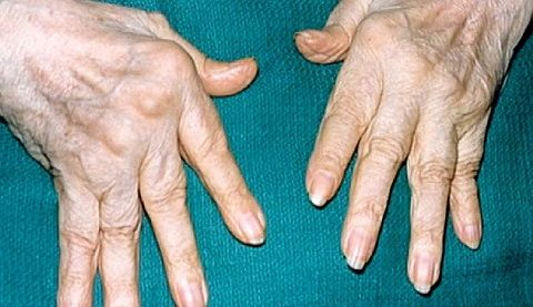 kaip pašalinti iš pirštų sąnarių patinimas tepalas gydant artrito rankas