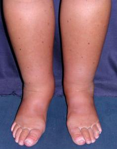 swells apatinėje kojos sąnarį vieta gydymas sąnarių