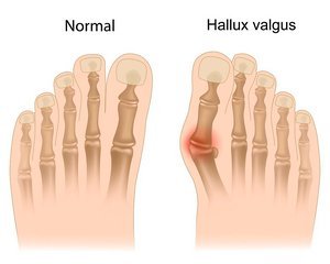 artrozė iš gydymo pėdų skauda pagal alkūnės sąnario