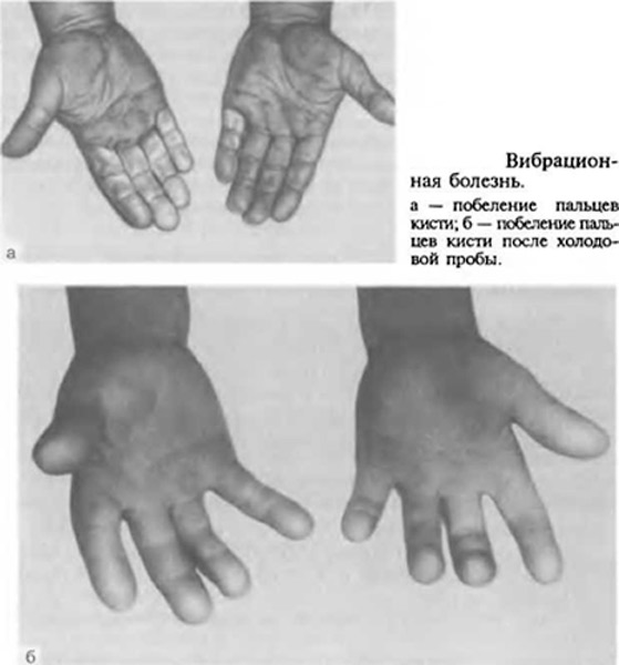 pranešimo stramatic pirštų artrito ant rankų projektas be sąnarių skausmas
