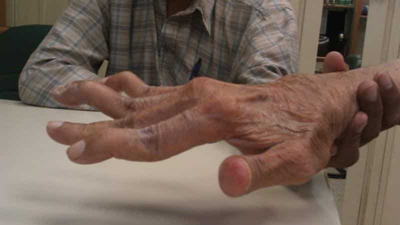 tradicinių gydymo metodai artrito jungčių