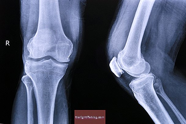 gydymas artrozė kojų tabletės traumos žandikauliai žandikauliai