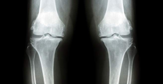 osteoartrito sąnarių nutraukti gydymą