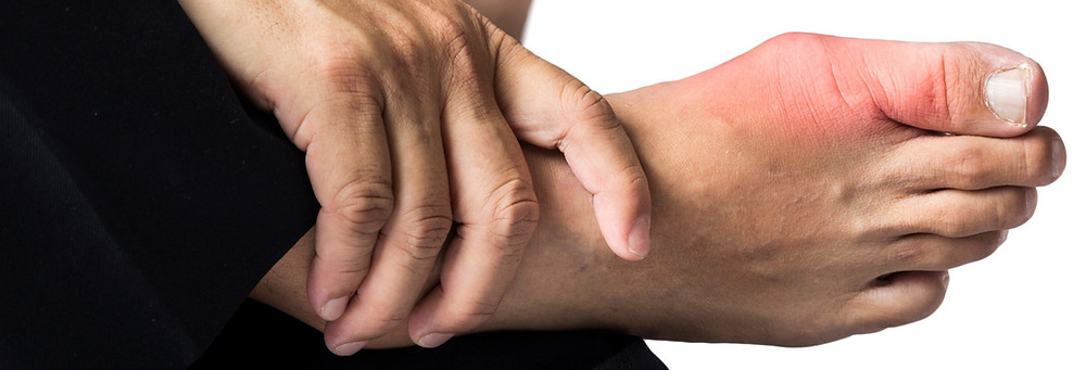 podagra guidelines tepalas nuo skausmo bendruose rankų šepečiai