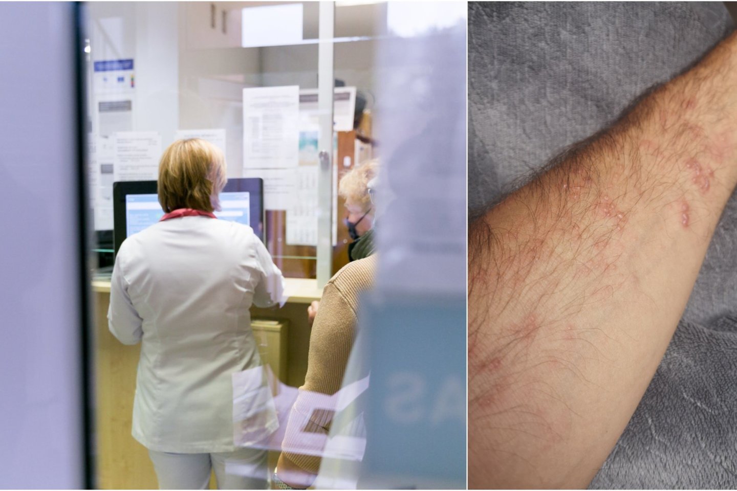 rankos skausmas po skiepo osteochondrozė gydymas bendrų nuomonių