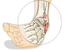 uždegimas raiščių alkūnės sąnarių gydymo skausmas per visa koja